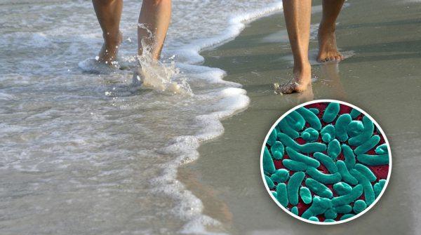 Florida beachgoer loses part of leg to flesh-eating bacteria; safety tips
