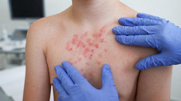 Measles Surge in the US: What Latinos Need to Know About the Outbreak