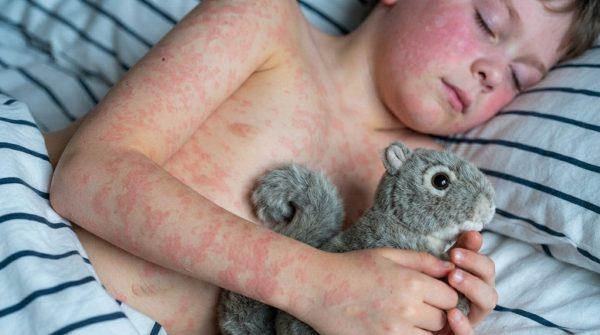 New York expands who can give measles shots as outbreak spreads